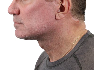 Deep Neck Lift Before & After Gallery - Patient 143555056 - Image 6