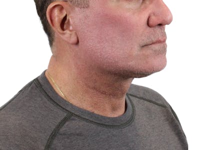 Deep Neck Lift Before & After Gallery - Patient 143555056 - Image 2