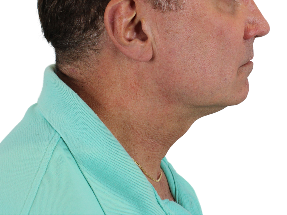 Deep Neck Lift Before & After Gallery - Patient 143555056 - Image 3