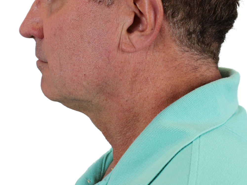 Deep Neck Lift Before & After Gallery - Patient 143555056 - Image 7
