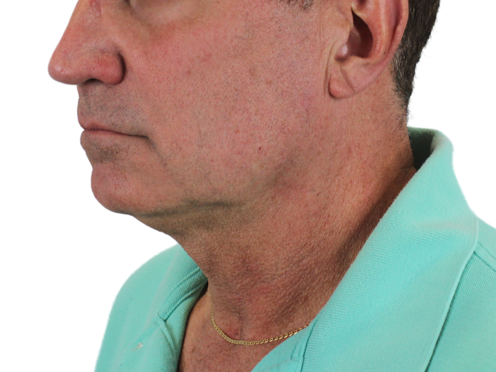 Deep Neck Lift Before & After Gallery - Patient 143555056 - Image 5