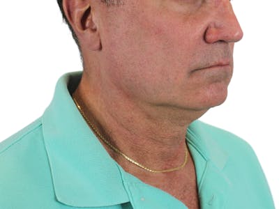 Deep Neck Lift Before & After Gallery - Patient 143555056 - Image 1