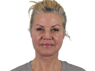 Deep Neck Lift Before & After Gallery - Patient 146130641 - Image 2