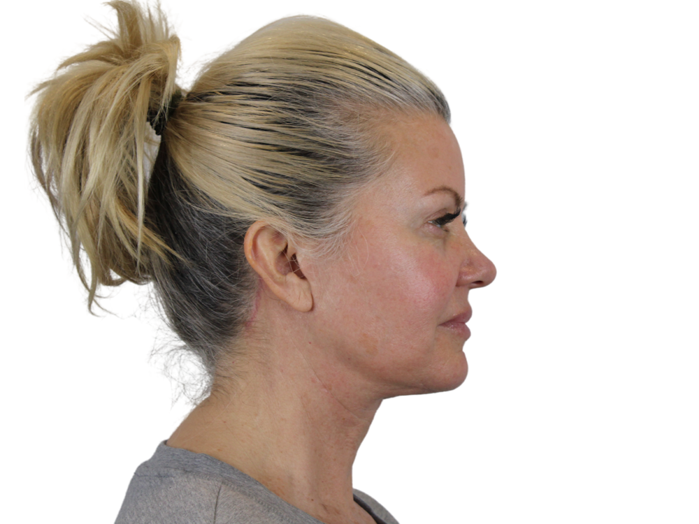 Deep Neck Lift Before & After Gallery - Patient 146130641 - Image 4