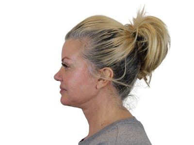 Deep Neck Lift Before & After Gallery - Patient 146130641 - Image 8