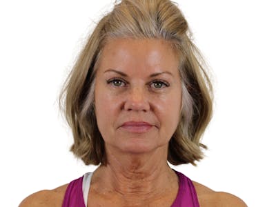 Deep Plane Facelift Before & After Gallery - Patient 146129892 - Image 1