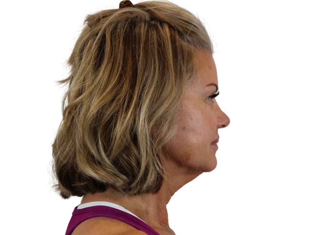 Deep Plane Facelift Before & After Gallery - Patient 146129892 - Image 3