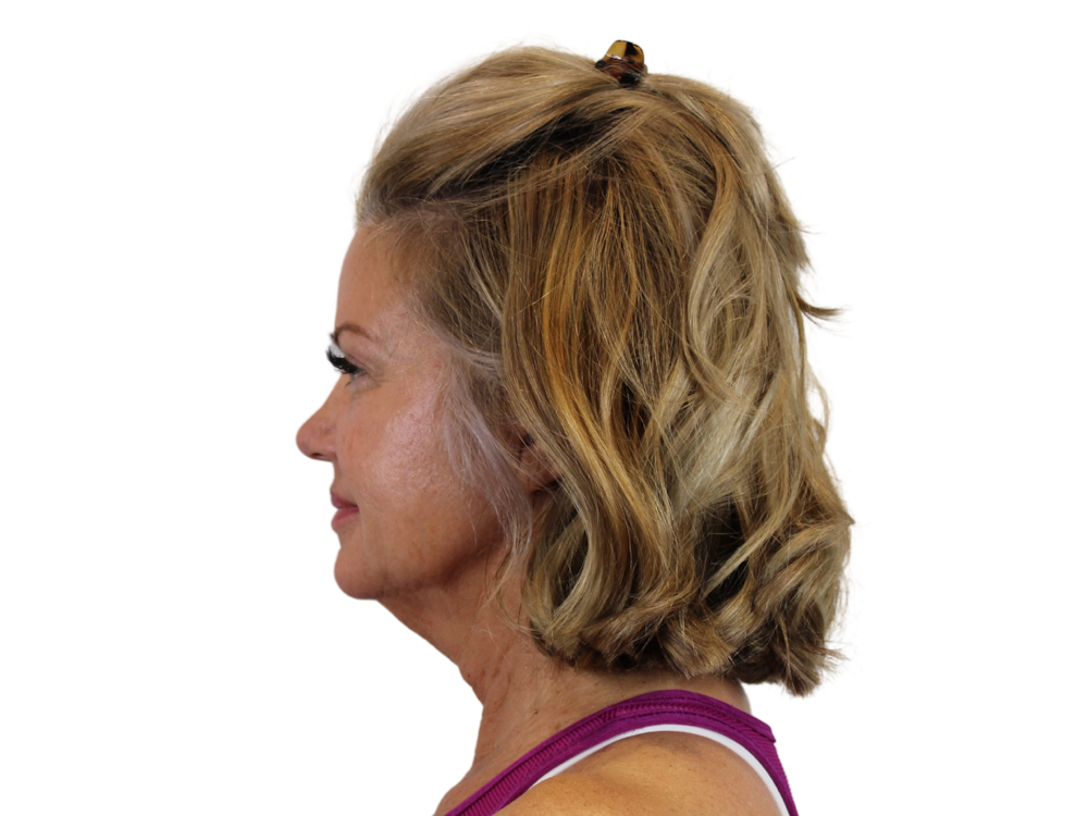 Deep Neck Lift Before & After Gallery - Patient 146130641 - Image 7