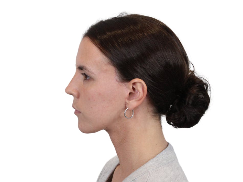 Before and after a deep plane facelift in Phoenix