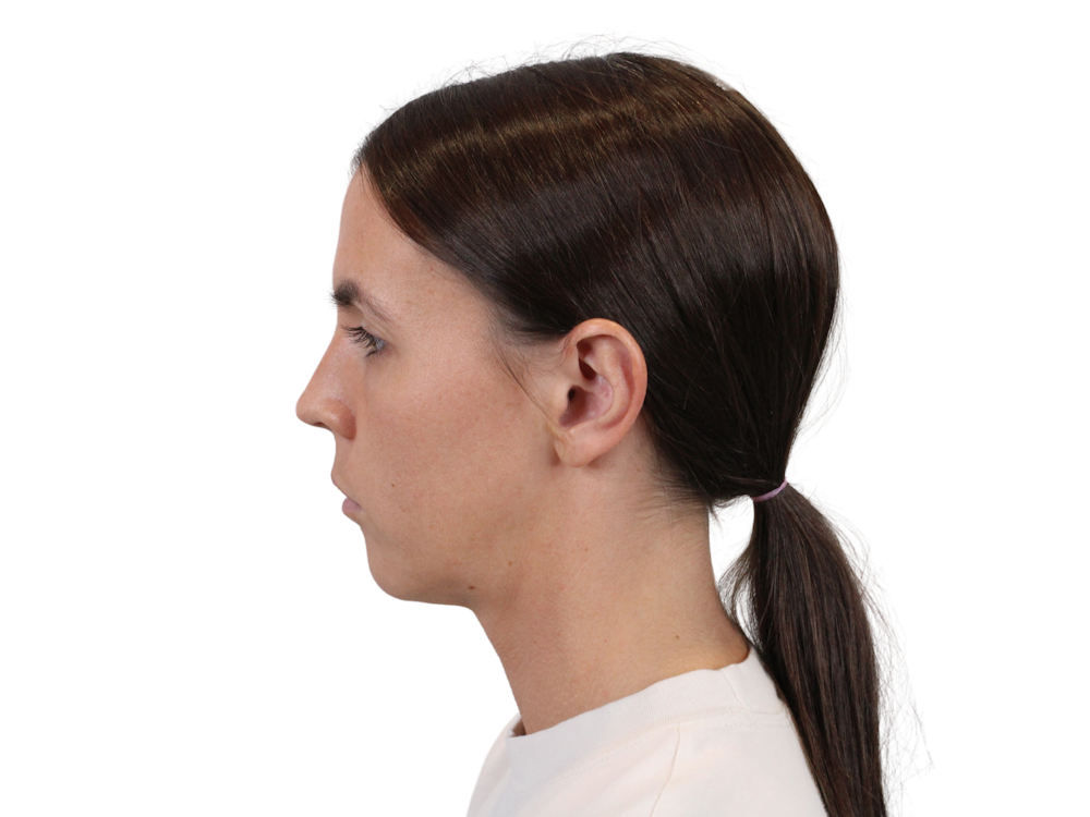 Deep Neck Lift Before & After Gallery - Patient 146130015 - Image 5