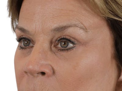 Blepharoplasty Before & After Gallery - Patient 146378682 - Image 4
