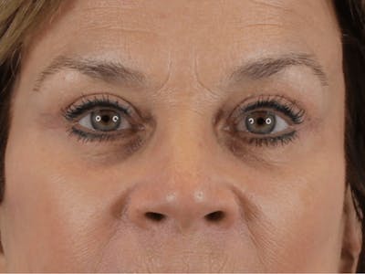 Blepharoplasty Before & After Gallery - Patient 146378682 - Image 2