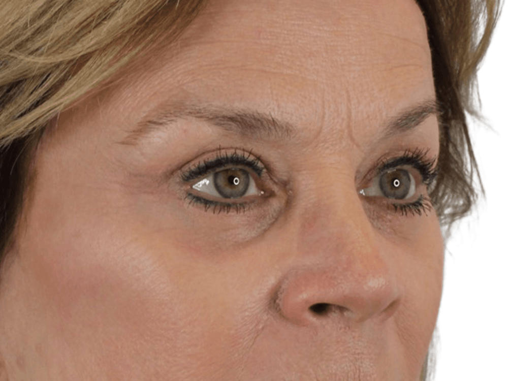 Blepharoplasty Before & After Gallery - Patient 146378682 - Image 6
