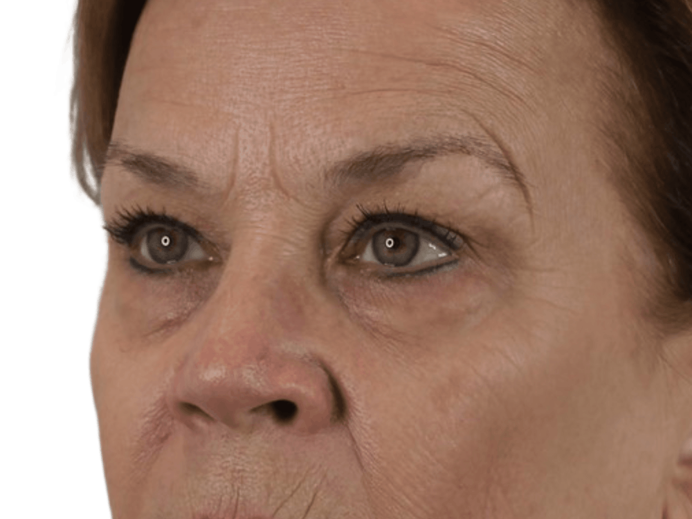 Blepharoplasty Before & After Gallery - Patient 146378682 - Image 3