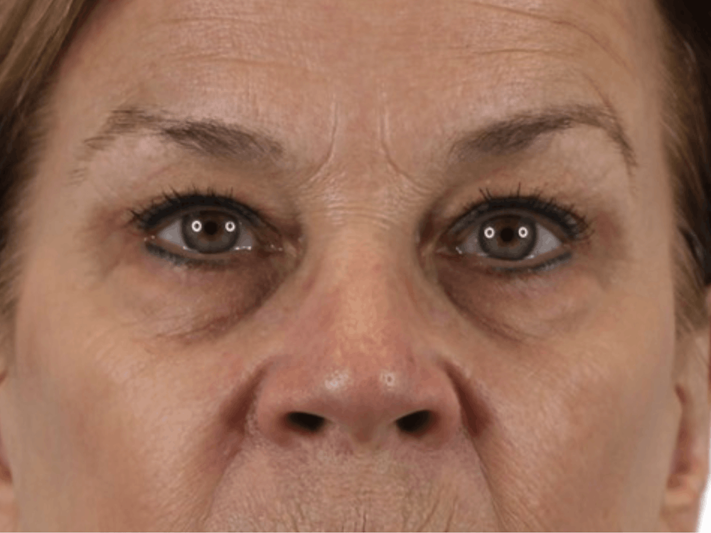 Blepharoplasty Before & After Gallery - Patient 146378682 - Image 1