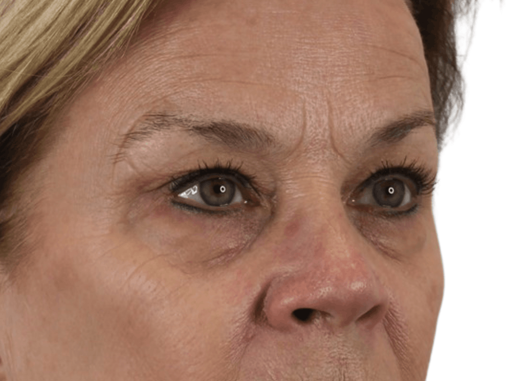 Blepharoplasty Before & After Gallery - Patient 146378682 - Image 5