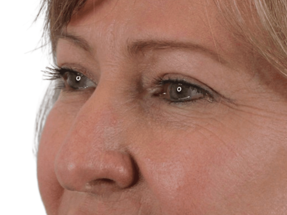 Blepharoplasty Before & After Gallery - Patient 146378683 - Image 2