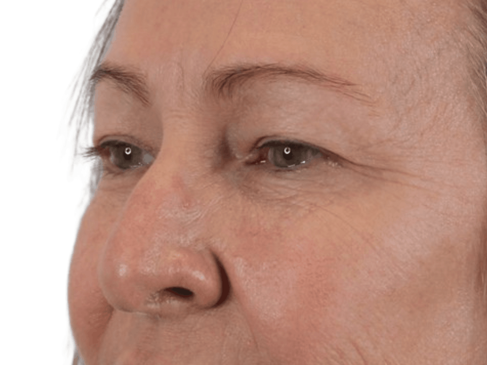 Blepharoplasty Before & After Gallery - Patient 146378683 - Image 1