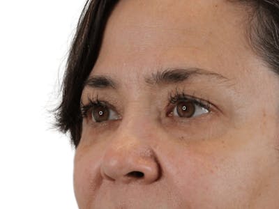 Blepharoplasty Before & After Gallery - Patient 146378685 - Image 1