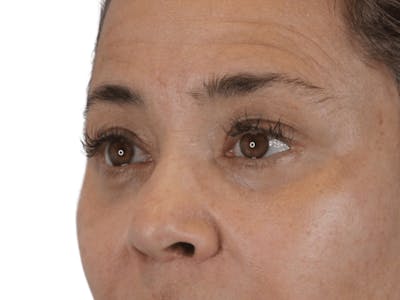 Blepharoplasty Before & After Gallery - Patient 146378685 - Image 2