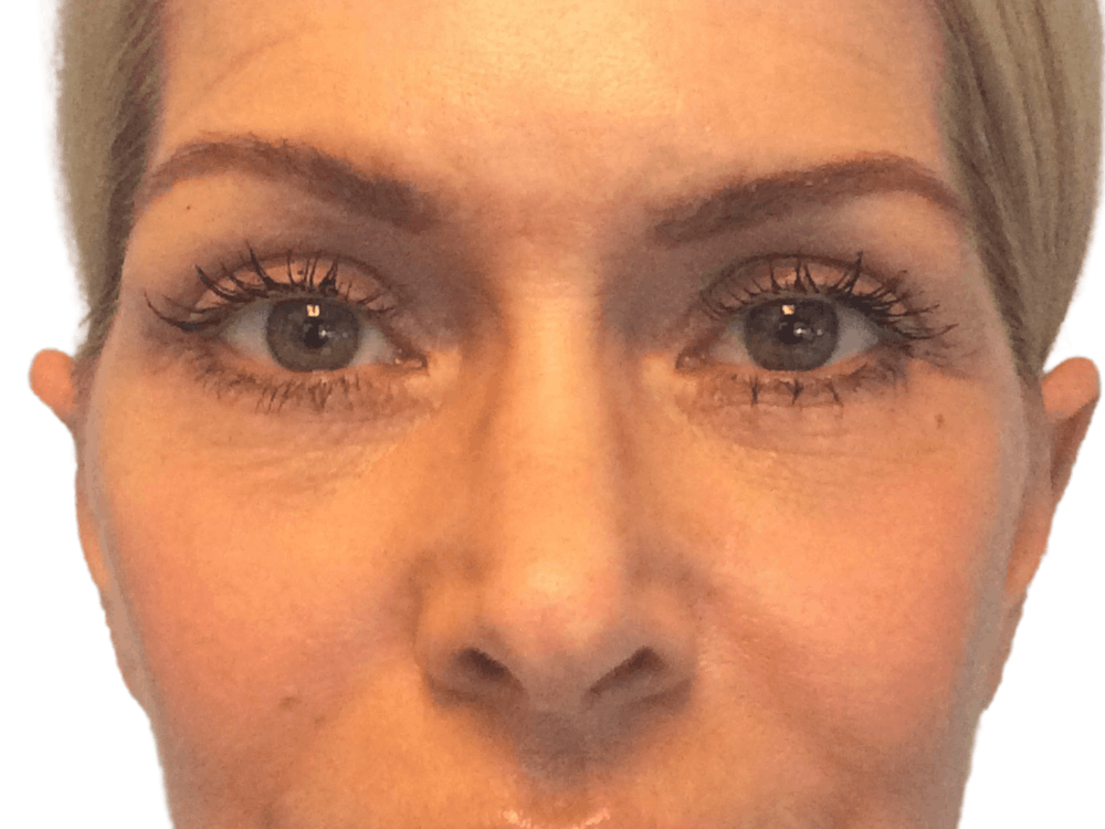 Blepharoplasty Before & After Gallery - Patient 146378686 - Image 2