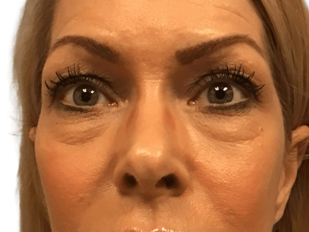 Blepharoplasty Before & After Gallery - Patient 146378686 - Image 1