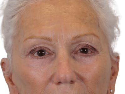 Blepharoplasty Before & After Gallery - Patient 146378687 - Image 2