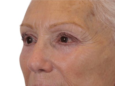 Blepharoplasty Before & After Gallery - Patient 146378687 - Image 4