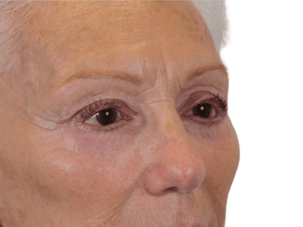 Blepharoplasty Before & After Gallery - Patient 146378687 - Image 6