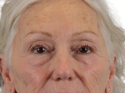 Blepharoplasty Before & After Gallery - Patient 146378687 - Image 1