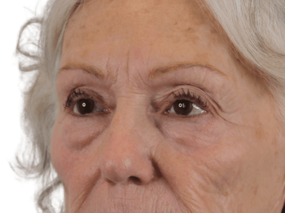 Blepharoplasty Before & After Gallery - Patient 146378687 - Image 3