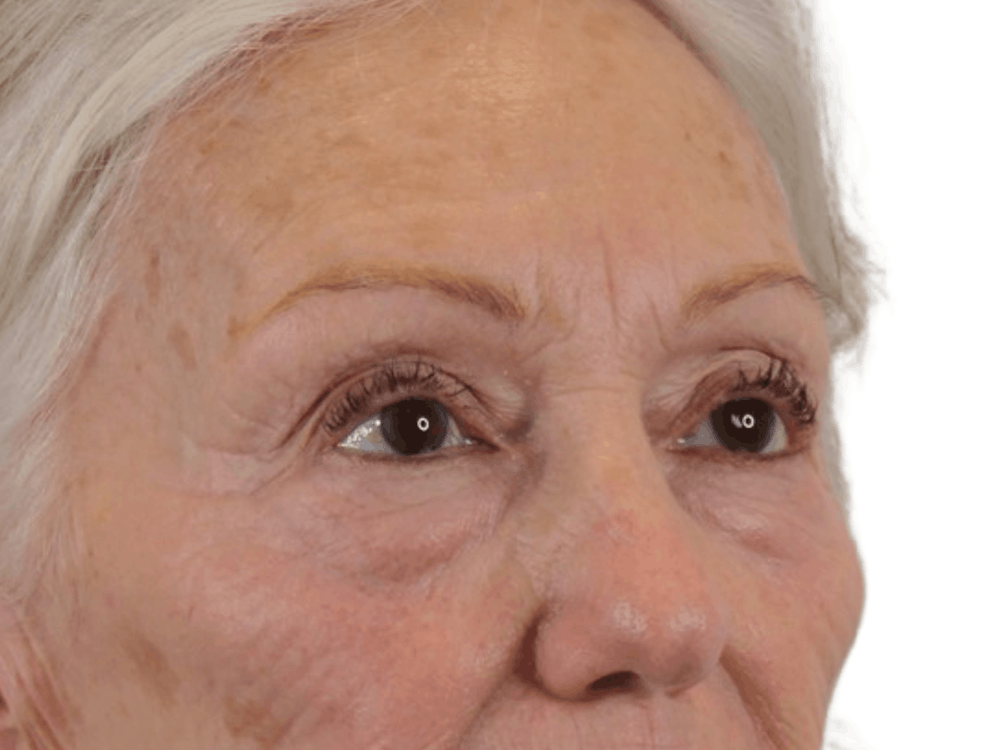 Blepharoplasty Before & After Gallery - Patient 146378687 - Image 5