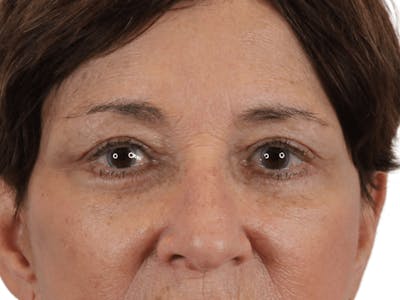 Blepharoplasty Before & After Gallery - Patient 146378688 - Image 2