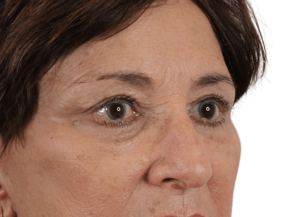 Blepharoplasty Before & After Gallery - Patient 146378688 - Image 4
