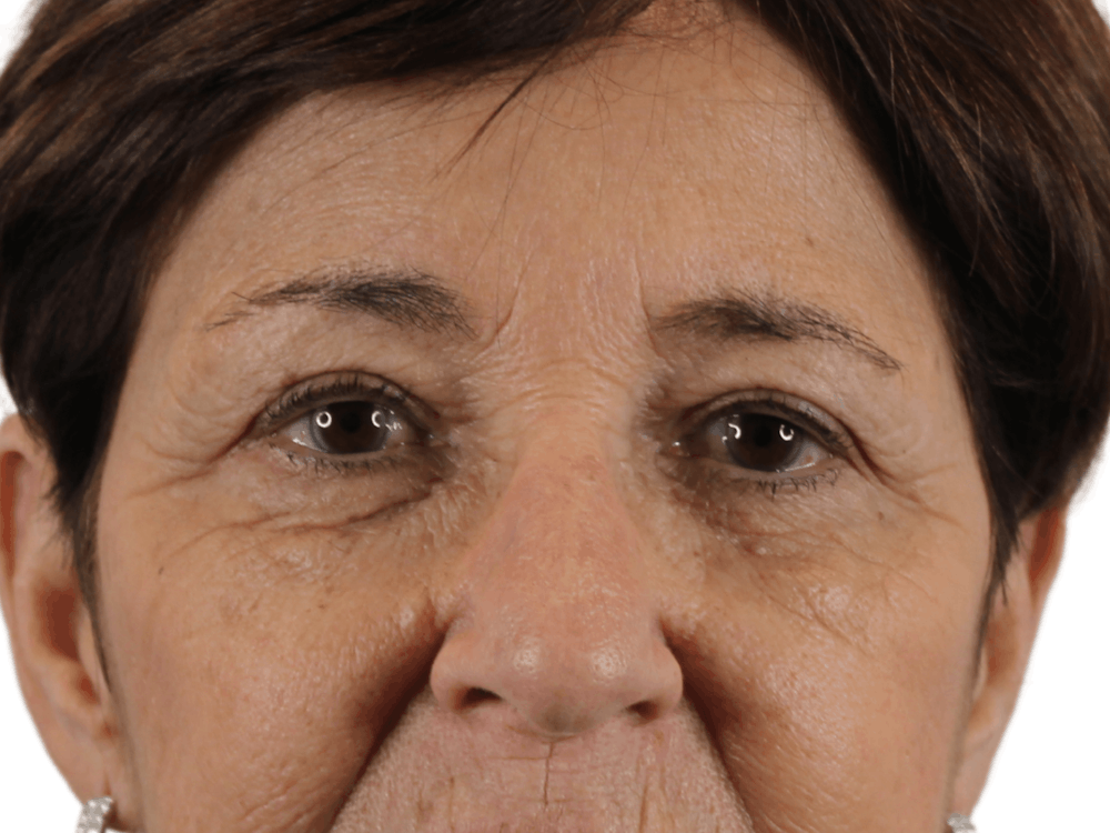 Blepharoplasty Before & After Gallery - Patient 146378688 - Image 1