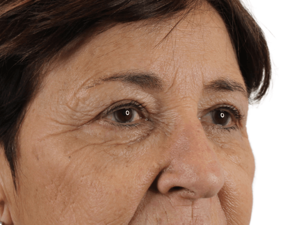 Blepharoplasty Before & After Gallery - Patient 146378688 - Image 3