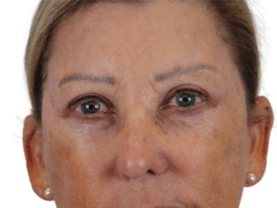 Blepharoplasty Before & After Gallery - Patient 146378689 - Image 2