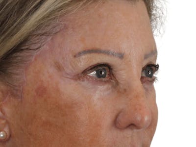 Blepharoplasty Before & After Gallery - Patient 146378689 - Image 4