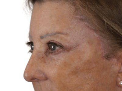 Blepharoplasty Before & After Gallery - Patient 146378689 - Image 6