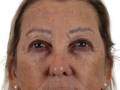 Blepharoplasty Before & After Gallery - Patient 146378689 - Image 1