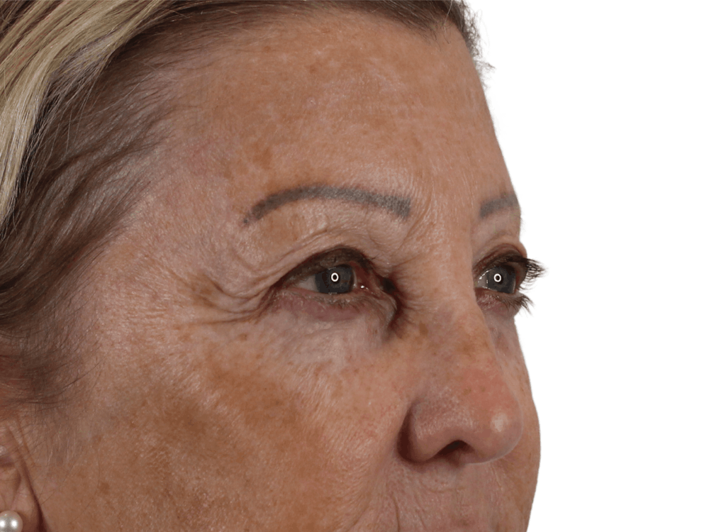 Blepharoplasty Before & After Gallery - Patient 146378689 - Image 3