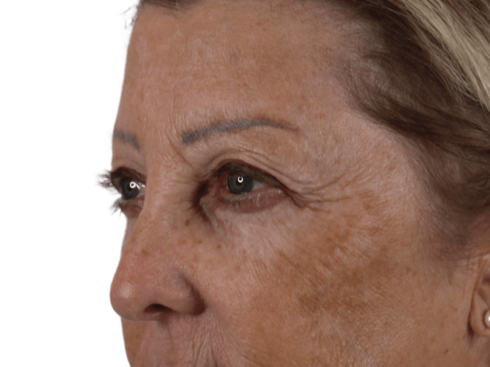 Blepharoplasty Before & After Gallery - Patient 146378689 - Image 5