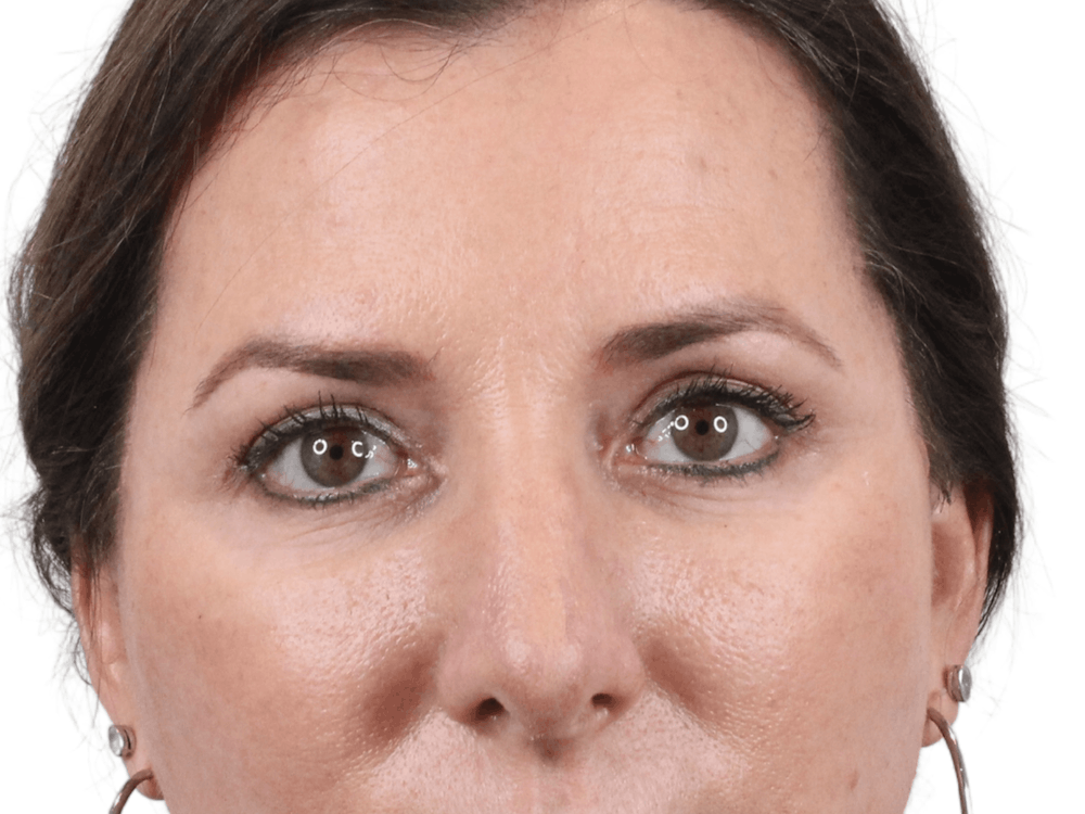 Blepharoplasty Before & After Gallery - Patient 146378690 - Image 2