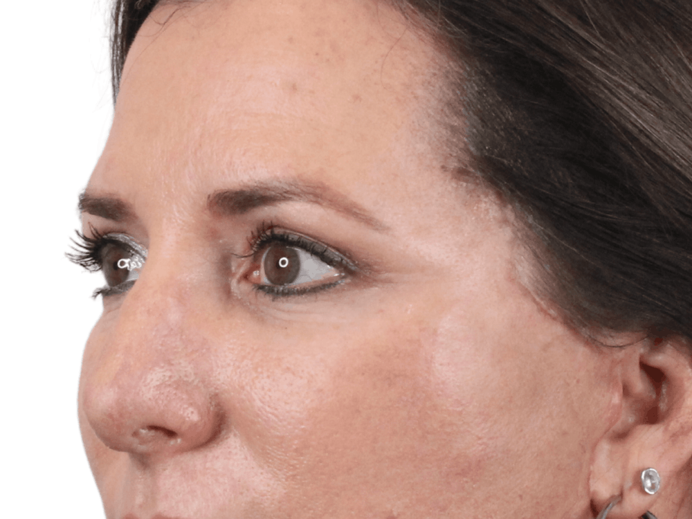 Blepharoplasty Before & After Gallery - Patient 146378690 - Image 4