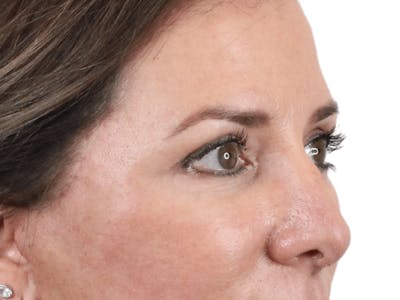 Blepharoplasty Before & After Gallery - Patient 146378690 - Image 6