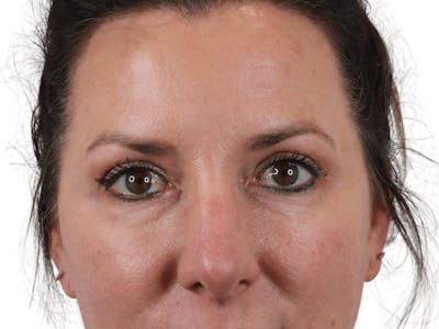 Blepharoplasty Before & After Gallery - Patient 146378690 - Image 1