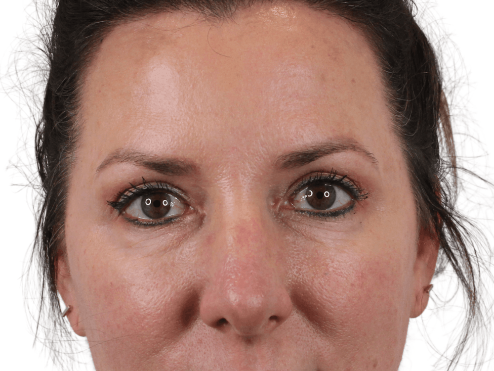Blepharoplasty Before & After Gallery - Patient 146378690 - Image 1