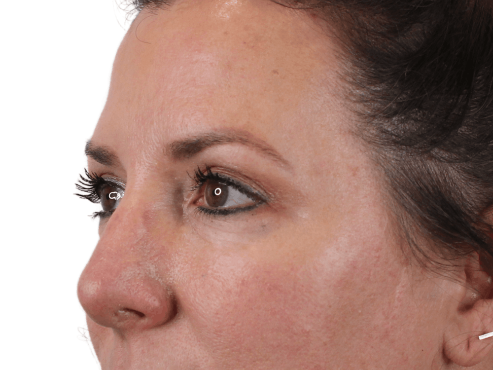 Blepharoplasty Before & After Gallery - Patient 146378690 - Image 3