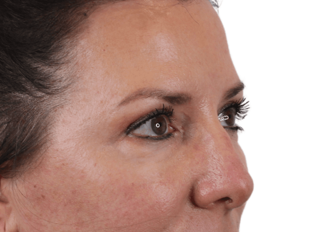 Blepharoplasty Before & After Gallery - Patient 146378690 - Image 5
