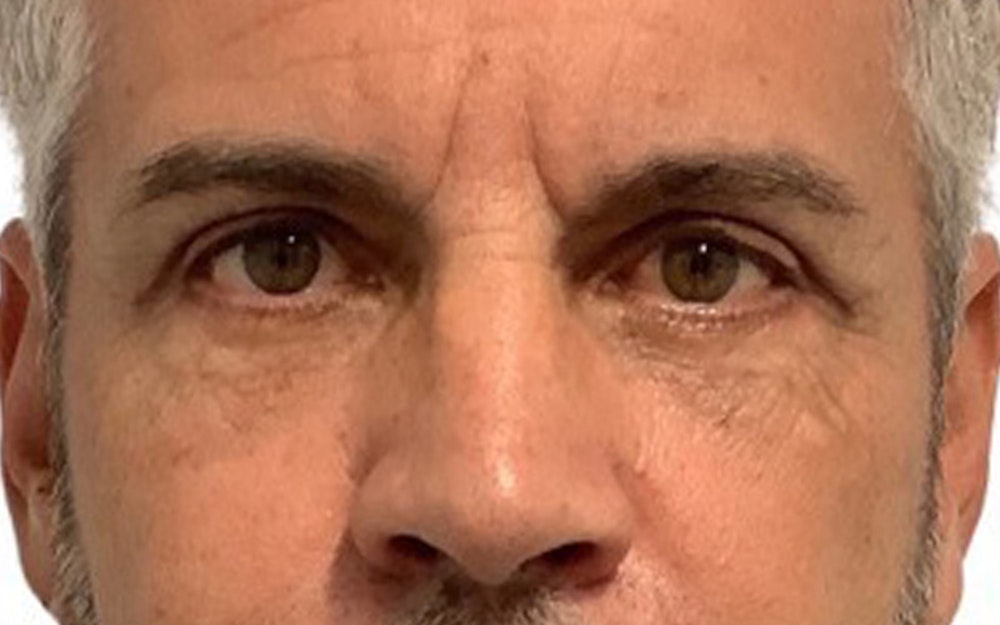 Blepharoplasty Before & After Gallery - Patient 13948445 - Image 2